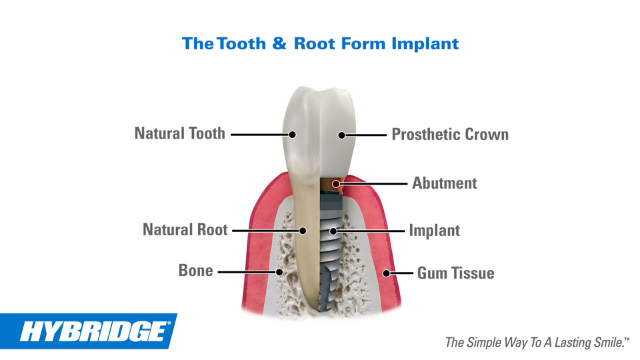 Hybridge Dental Implant Solutions